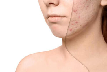 Acne and its treatment