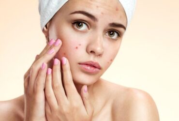 Acne scar reduction