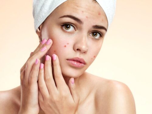 acne-treatment