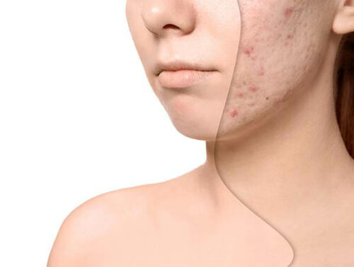 2acne-treatment